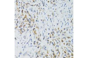 Immunohistochemistry of paraffin-embedded human colon carcinoma using SRP19 antibody (ABIN2560139) at dilution of 1:100 (40x lens). (SRP19 抗体)