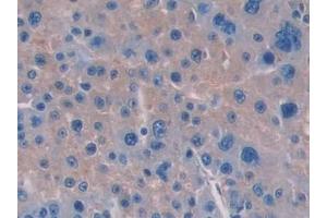 Detection of IL15 in Human Liver cancer Tissue using Polyclonal Antibody to Interleukin 15 (IL15) (IL-15 抗体  (AA 50-162))