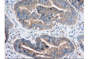 Immunohistochemistry (IHC) image for anti-Insulin-Like Growth Factor 2 mRNA Binding Protein 2 (IGF2BP2) antibody (ABIN1498821) (IGF2BP2 抗体)