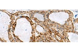 Immunohistochemistry of paraffin-embedded Human thyroid cancer tissue using MED31 Polyclonal Antibody at dilution of 1:100(x200) (MED31 抗体)