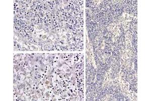Immunohistochemistry of HumanIL1beta_antibod Tissue: medullary lymph node Fixation: formalin fixed paraffin embedded Antigen retrieval: user optimized Primary antibody: Human IL1beta antibody Secondary antibody: Peroxidase goat anti-rabbit at 1:10,000 for 45 min at RT Localization: cytoplasm Staining: Close up of medullary lymph node: positive staining in the cytoplasm of circulating macrophages.