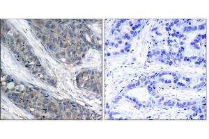Immunohistochemical analysis of paraffin-embedded human breast carcinoma tissue, using IRS-1 (phospho-Ser307) antibody (E011235). (IRS1 抗体  (pSer307))