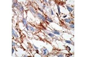 IHC analysis of FFPE human breast carcinoma tissue stained with the ISG15 antibody
