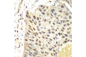 Immunohistochemistry of paraffin-embedded human lung cancer using FEN1 antibody. (FEN1 抗体  (AA 50-380))