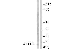 Immunohistochemical analysis of paraffin-embedded human colon carcinoma tissue using 4E-BP1 (Ab-64) antibody. (eIF4EBP1 抗体  (Ser65))