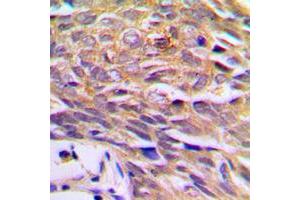 Immunohistochemical analysis of p23 staining in human prostate cancer formalin fixed paraffin embedded tissue section. (CDK5R1 抗体  (Center))
