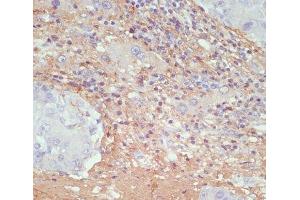 Immunohistochemistry of paraffin-embedded Human liver cancer using COL1A1 Polyclonal Antibody at dilution of 1:200 (40x lens). (COL1A1 抗体)