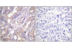 Immunohistochemistry analysis of paraffin-embedded human breast carcinoma tissue, using A-RAF (Ab-301/302) Antibody. (ARAF 抗体  (AA 276-325))