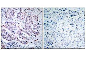 Immunohistochemical analysis of paraffin-embedded human breast carcinoma tissue, using TYK2 (Ab-1054) antibody (E021118). (TYK2 抗体)