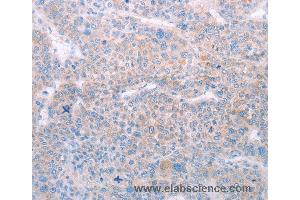 Immunohistochemistry of Human lung cancer using SPATA6 Polyclonal Antibody at dilution of 1:50 (SPATA6 抗体)