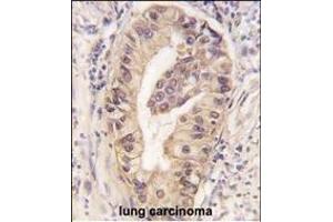 Formalin-fixed and paraffin-embedded human lung carcinoma tissue reacted with ATG16L1 Monoclonal Antibody (ABIN6243484 and ABIN6577053) , which was peroxidase-conjugated to the secondary antibody, followed by DAB staining. (ATG16L1 抗体)