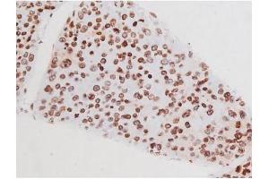 Immunohistochemistry (IHC) image for anti-Mast/stem Cell Growth Factor Receptor (KIT) (pTyr721) antibody (ABIN6256004)