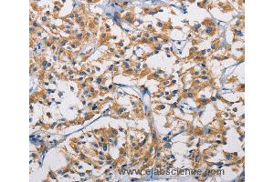 Immunohistochemistry of Human colon cancer using HK1 Polyclonal Antibody at dilution of 1:50 (Hexokinase 1 抗体)