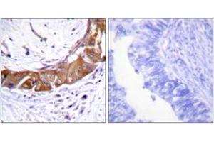 Immunohistochemistry analysis of paraffin-embedded human colon carcinoma, using IRAK1 (Phospho-Thr100) Antibody. (IRAK1 抗体  (pThr100))