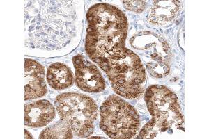 ABIN6267641 at 1/200 staining human kidney carcinoma tissue sections by IHC-P. (eIF4EBP1 抗体  (pThr45))