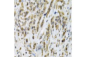 Immunohistochemistry of paraffin-embedded human gastric cancer using RhoA Antibody (ABIN6292258) at dilution of 1:100 (40x lens). (RHOA 抗体)