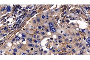 Detection of ITGaV in Human Lung cancer Tissue using Polyclonal Antibody to Integrin Alpha V (ITGaV) (CD51 抗体  (AA 560-744))