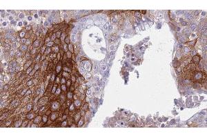 ABIN6272334 at 1/100 staining Human urothelial cancer tissue by IHC-P. (KCNJ3 抗体  (Internal Region))