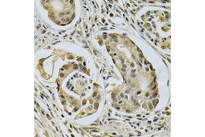 Immunohistochemistry of paraffin-embedded human gastric cancer using LGALS3 Antibody (ABIN5970683) at dilution of 1/200 (40x lens). (Galectin 3 抗体)