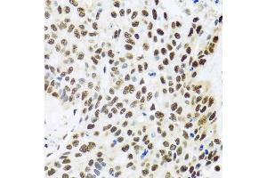 Immunohistochemistry of paraffin-embedded human lung cancer using FUBP1 antibody (ABIN6130392, ABIN6140802, ABIN6140804 and ABIN6221231) at dilution of 1:100 (40x lens). (FUBP1 抗体  (AA 302-644))