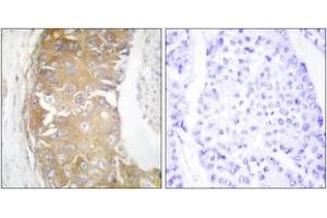 Immunohistochemistry analysis of paraffin-embedded human breast carcinoma tissue, using FRK Antibody. (FRK 抗体  (AA 71-120))