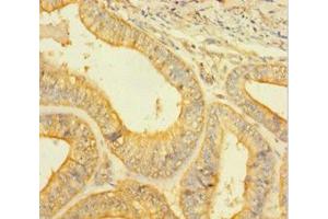 Immunohistochemistry of paraffin-embedded human endometrial cancer using ABIN7146926 at dilution of 1:100 (Caspase 1 抗体  (AA 120-269))