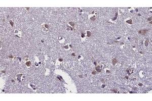 ABIN6276443 at 1/100 staining Human brain cancer tissue by IHC-P. (TLR7 抗体  (Internal Region))