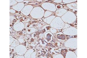 Immunohistochemistry of paraffin-embedded Human breast cancer using TAX1BP1 Polyclonal Antibody at dilution of 1:100 (40x lens). (TAX1BP1 抗体)
