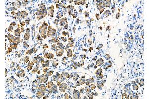 ABIN6264112 and ABIN6277799 at 1/100 staining Human pancreatic cancer and adjacent nomal tissues by IHC-P. (PDIA2 抗体  (C-Term))