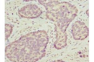 Immunohistochemistry of paraffin-embedded human gastric cancer using ABIN7162208 at dilution of 1:100 (Oligophrenin 1 抗体  (AA 1-270))