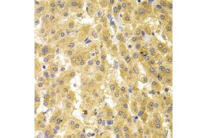 Immunohistochemistry of paraffin-embedded human liver cancer using GMNN antibody. (Geminin 抗体)