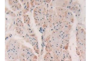 Detection of MYLK in Human Esophagus cancer Tissue using Polyclonal Antibody to Myosin Light Chain Kinase (MYLK) (MYLK 抗体  (AA 1661-1877))