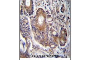 RAB21 Antibody (C-term) (ABIN657300 and ABIN2846383) immunohistochemistry analysis in formalin fixed and paraffin embedded human colon carcinoma followed by peroxidase conjugation of the secondary antibody and DAB staining. (RAB21 抗体  (C-Term))