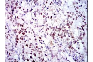 Immunohistochemical analysis of paraffin-embedded cervical cancer tissues using CDK2 mouse mAb with DAB staining.