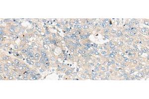 Immunohistochemistry of paraffin-embedded Human liver cancer tissue using ZNF449 Polyclonal Antibody at dilution of 1:50(x200) (ZNF449 抗体)