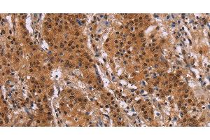 Immunohistochemistry of paraffin-embedded Human gastic cancer using FOSL1 Polyclonal Antibody at dilution of 1:30 (FOSL1 抗体)