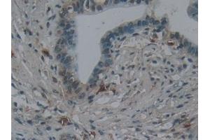 Detection of NPNT in Human Pancreatic cancer Tissue using Polyclonal Antibody to Nephronectin (NPNT)