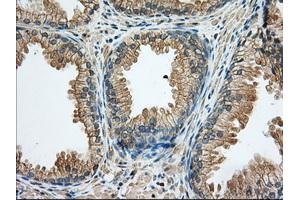 Immunohistochemical staining of paraffin-embedded Human liver tissue using anti-RAB17 mouse monoclonal antibody. (RAB17 抗体)