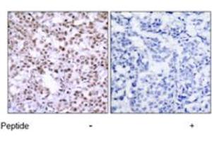 Immunohistochemical analysis of paraffin-embedded human breast carcinoma tissue using CHEK2 polyclonal antibody  . (CHEK2 抗体)