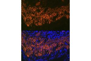 Immunofluorescence analysis of human colon carcinoma using Calponin Rabbit mAb (ABIN1678670, ABIN3018018, ABIN3018019 and ABIN7101568) at dilution of 1:100 (40x lens). (CNN1 抗体)