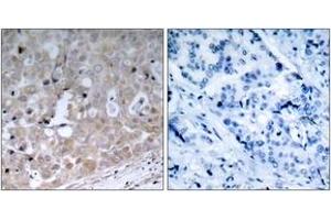 Immunohistochemistry analysis of paraffin-embedded human breast carcinoma tissue, using VEGFR2 (Ab-1175) Antibody. (VEGFR2/CD309 抗体  (AA 1141-1190))