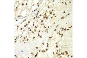 Immunohistochemistry of paraffin-embedded human kidney cancer using RPA2 Antibody (ABIN5971215) at dilution of 1/100 (40x lens). (RPA2 抗体)