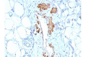 Formalin-fixed, paraffin-embedded human Breast Carcinoma stained with SM-MHC Recombinant Rabbit Monoclonal Antibody (MYH11/2303R). (Recombinant MYH11 抗体)