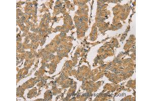 Immunohistochemistry of Human breast cancer using DMRT3 Polyclonal Antibody at dilution of 1:50 (DMRT3 抗体)