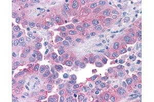 Anti-T1R1 / TAS1R1 antibody IHC of human Lung, Non-Small Cell Carcinoma. (TAS1R1 抗体  (Cytoplasmic Domain))
