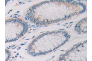 Detection of RNASE10 in Human Colorectal cancer Tissue using Polyclonal Antibody to Ribonuclease A10 (RNASE10) (Ribonuclease A10 (AA 27-216) 抗体)