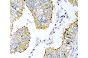 Immunohistochemistry of paraffin-embedded Human colon carcinoma using KRBOX4 Polyclonal Antibody at dilution of 1:200 (40x lens). (KRAB Box Domain Containing 4 (KRBOX4) 抗体)