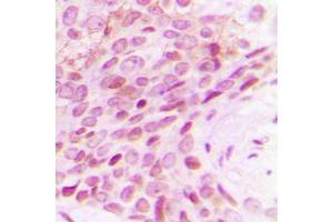 Immunohistochemical analysis of POLR2E staining in human breast cancer formalin fixed paraffin embedded tissue section. (POLR2E 抗体  (Center))