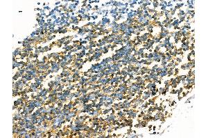 ABIN7094516 and ABIN7098565 at 1/100 staining Human breast cancer by IHC-P. (CD20 抗体  (C-Term))