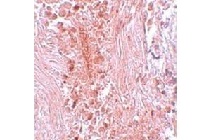 Immunohistochemical staining of human breast cancer tissue with PIAS3 polyclonal antibody  at 5 ug/mL dilution. (PIAS3 抗体  (C-Term))